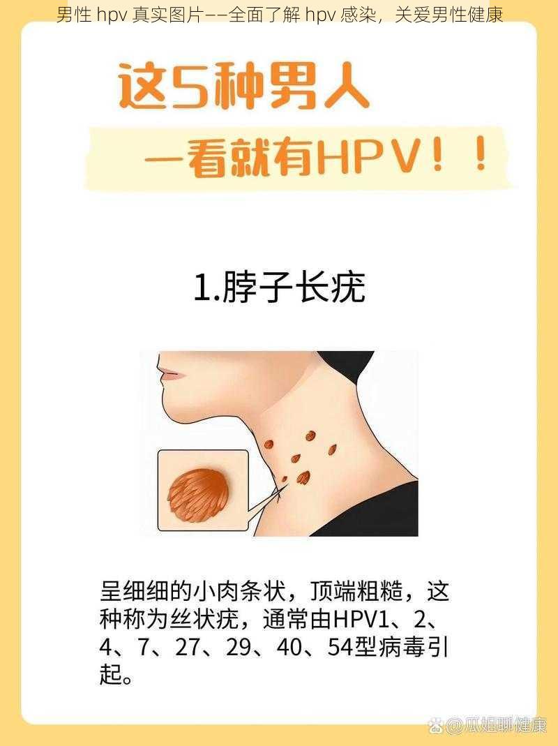 男性 hpv 真实图片——全面了解 hpv 感染，关爱男性健康